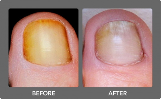 Before and After - Nuvolase, Inc
