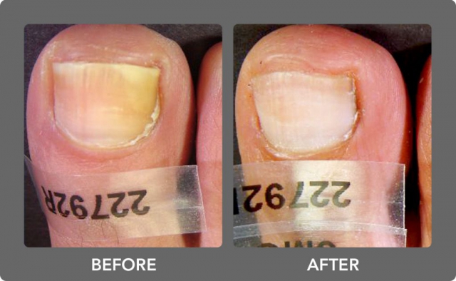 Before and After - Nuvolase, Inc