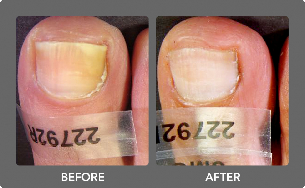 Toenail Fungus Treatment With Pinpointe Foot Laser Photo Gallery - NuvoLase